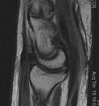 Scapholunate Injury Increased Lunate Capitate Angle